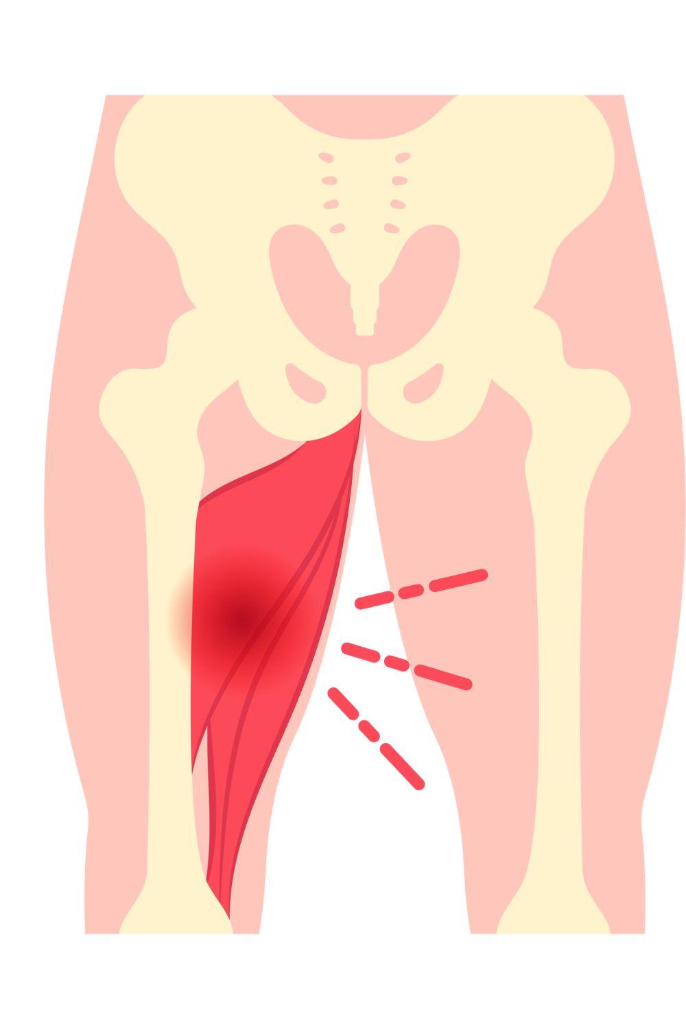 Inner thigh/groin pain